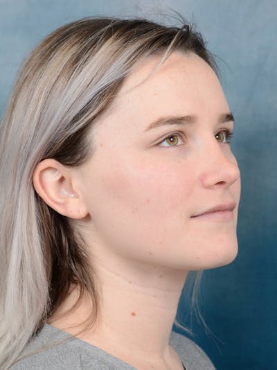 Rhinoplasty Before & After Gallery - Patient 117545553 - Image 8