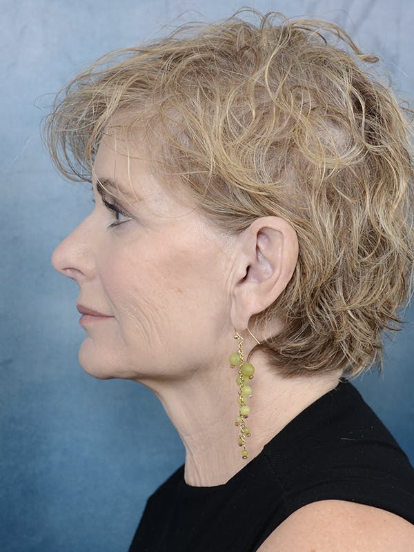 Deep Plane Facelift Before & After Gallery - Patient 120812965 - Image 5