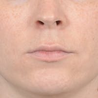 Lip Lift Before & After Gallery - Patient 120812982 - Image 1