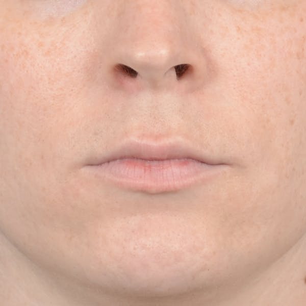 Lip Lift Before & After Gallery - Patient 120812982 - Image 1