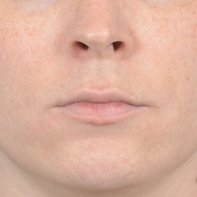 Lip Lift Before & After Gallery - Patient 120812982 - Image 1