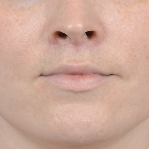 Lip Lift Before & After Gallery - Patient 120812982 - Image 2