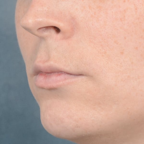 Lip Lift Before & After Gallery - Patient 120812982 - Image 3