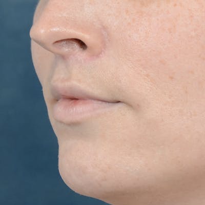 Lip Lift Before & After Gallery - Patient 120812982 - Image 4
