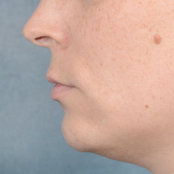 Lip Lift Before & After Gallery - Patient 120812982 - Image 5