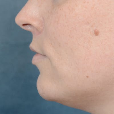 Lip Lift Before & After Gallery - Patient 120812982 - Image 6