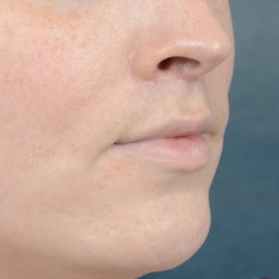 Lip Lift Before & After Gallery - Patient 120812982 - Image 8