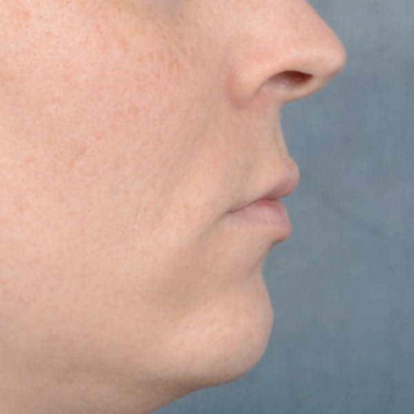 Lip Lift Before & After Gallery - Patient 120812982 - Image 9
