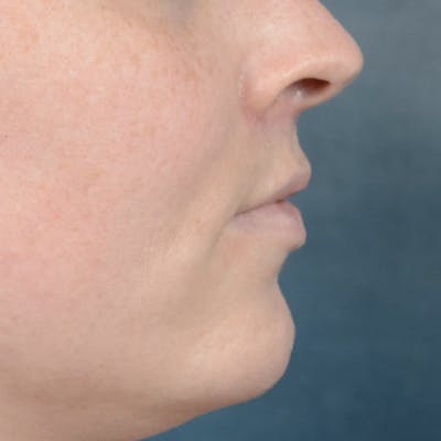 Lip Lift Before & After Gallery - Patient 120812982 - Image 10
