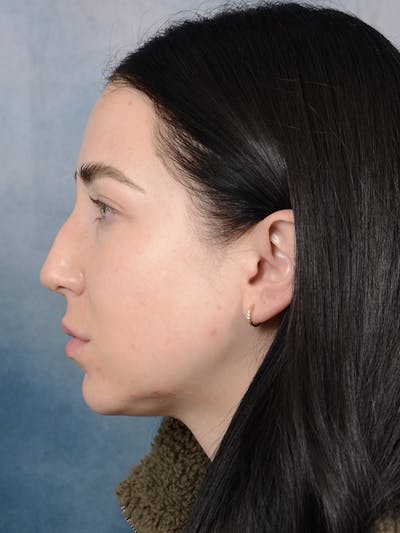 Rhinoplasty Before & After Gallery - Patient 120814100 - Image 1