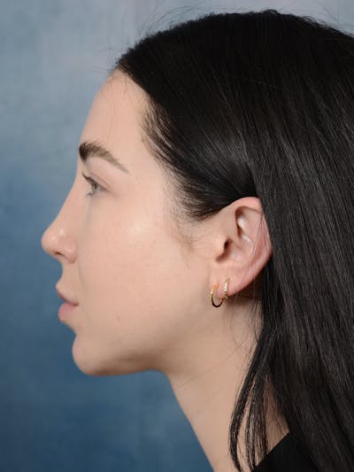 Rhinoplasty Before & After Gallery - Patient 120814100 - Image 2