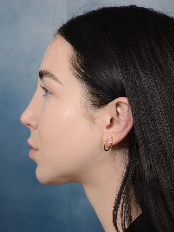 Rhinoplasty Before & After Gallery - Patient 120814100 - Image 2