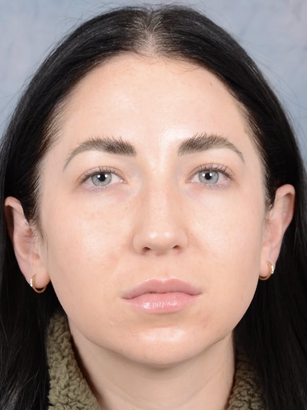Rhinoplasty Before & After Gallery - Patient 120814100 - Image 3