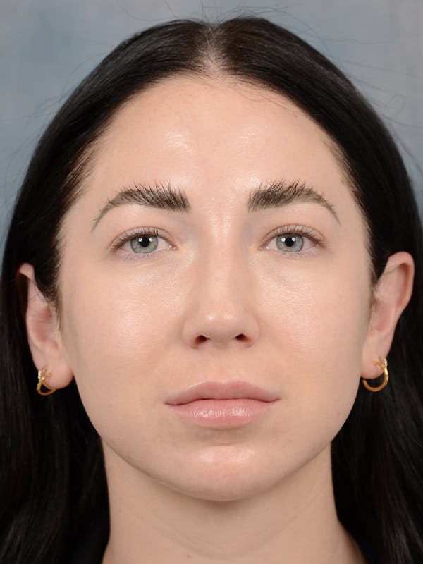 Rhinoplasty Before & After Gallery - Patient 120814100 - Image 4