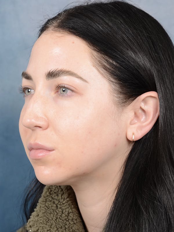 Rhinoplasty Before & After Gallery - Patient 120814100 - Image 5