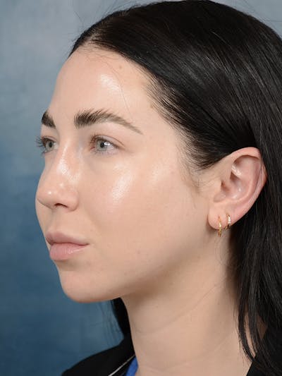 Rhinoplasty Before & After Gallery - Patient 120814100 - Image 6