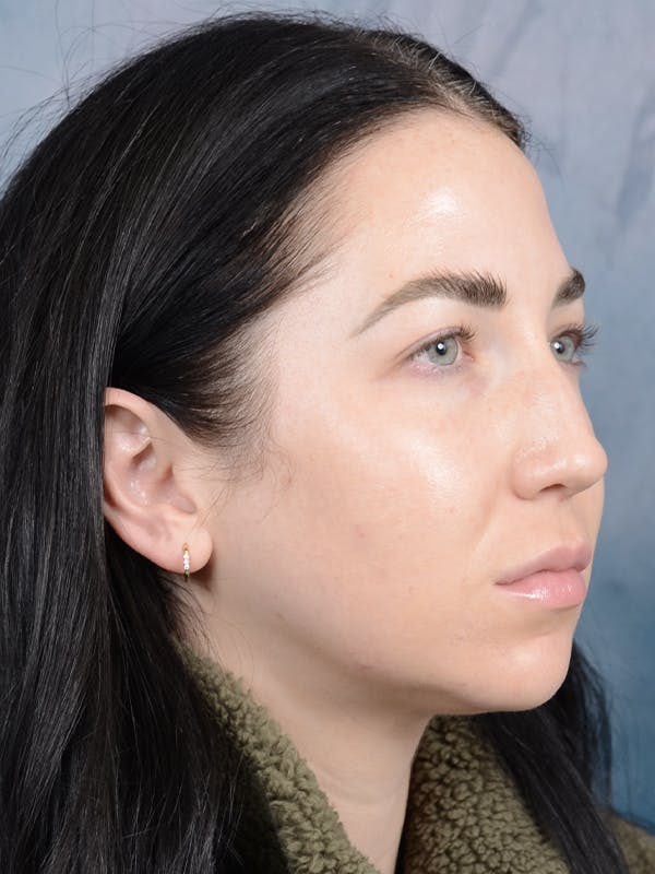 Rhinoplasty Before & After Gallery - Patient 120814100 - Image 7