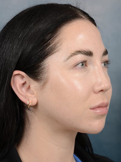 Rhinoplasty Before & After Gallery - Patient 120814100 - Image 8