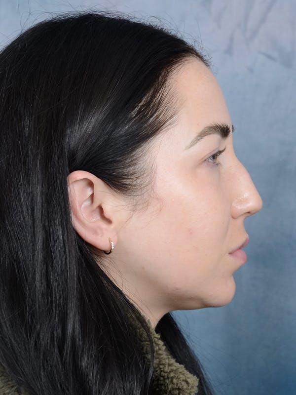 Rhinoplasty Before & After Gallery - Patient 120814100 - Image 9