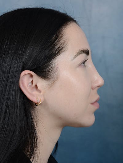 Rhinoplasty Before & After Gallery - Patient 120814100 - Image 10
