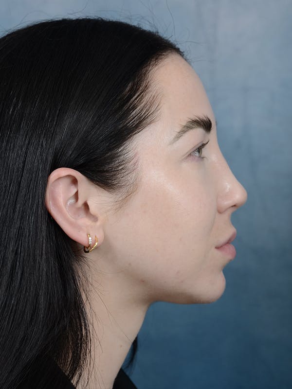Rhinoplasty Before & After Gallery - Patient 120814100 - Image 10