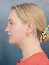 Rhinoplasty Before & After Gallery - Patient 121118809 - Image 1