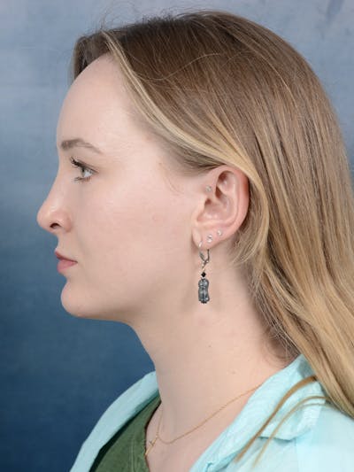 Rhinoplasty Before & After Gallery - Patient 121118809 - Image 2