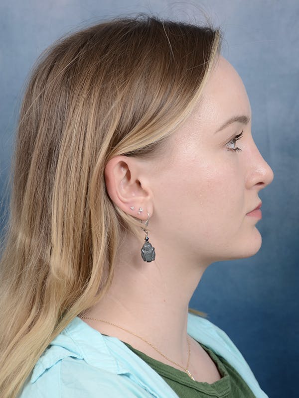 Rhinoplasty Before & After Gallery - Patient 121118809 - Image 10