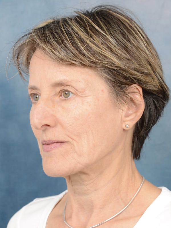 Rhinoplasty Before & After Gallery - Patient 121118868 - Image 5