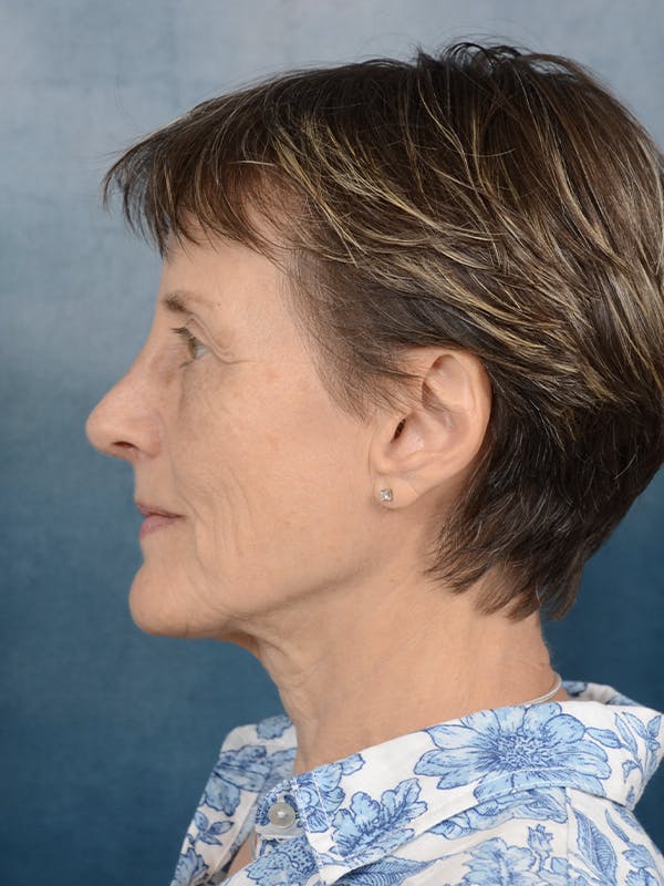 Rhinoplasty Before & After Gallery - Patient 121118868 - Image 2