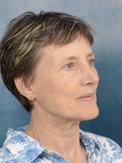 Rhinoplasty Before & After Gallery - Patient 121118868 - Image 8