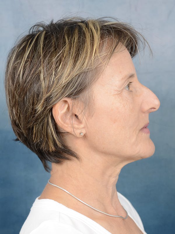 Rhinoplasty Before & After Gallery - Patient 121118868 - Image 9
