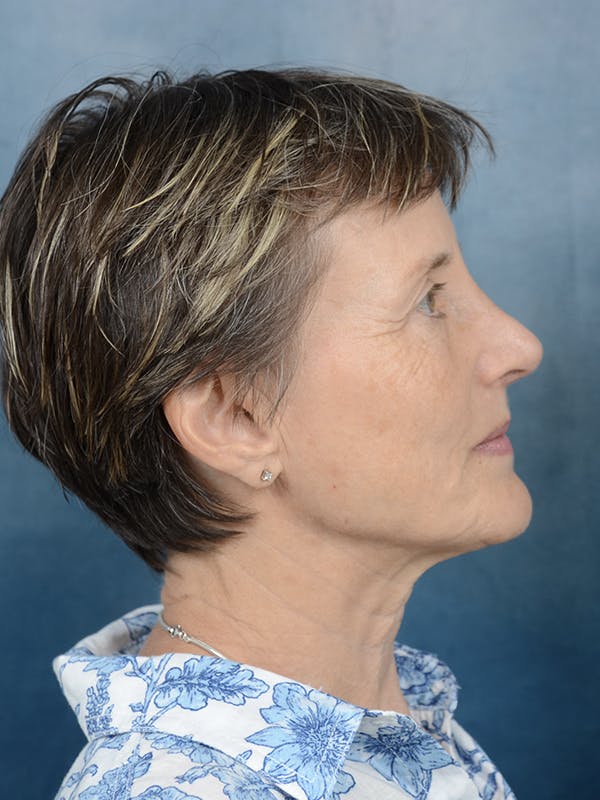 Rhinoplasty Before & After Gallery - Patient 121118868 - Image 10