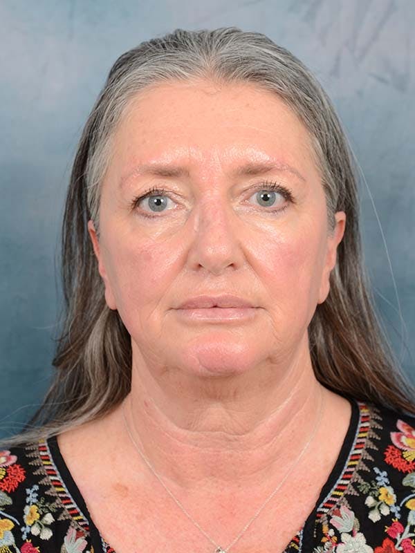 Brow Lift Before & After Gallery - Patient 121440601 - Image 1