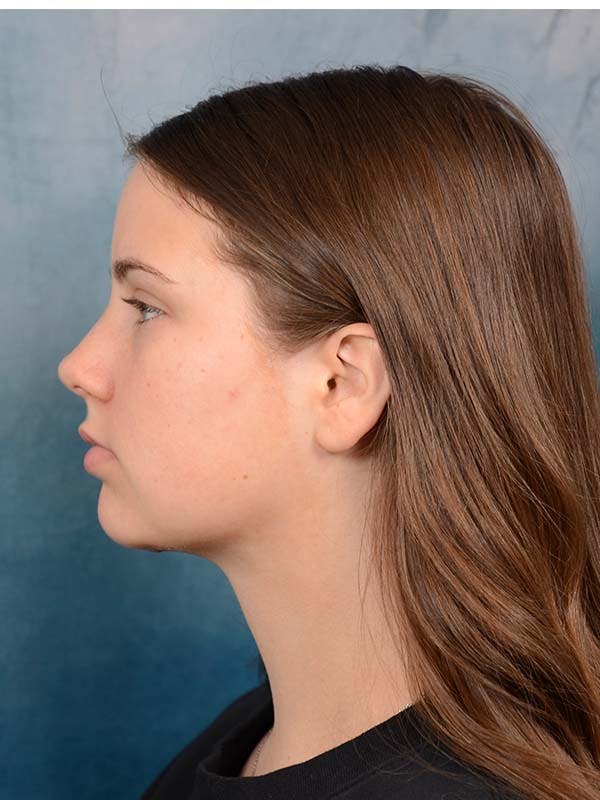 Deep Neck Lift Before & After Gallery - Patient 121440797 - Image 8