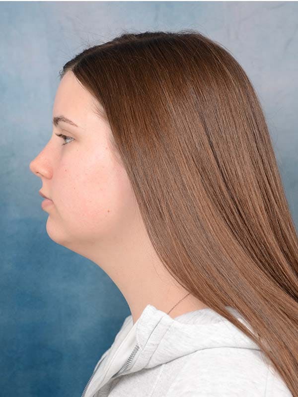 Deep Neck Lift Before & After Gallery - Patient 121440797 - Image 7