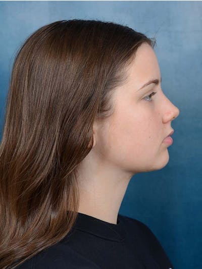 Deep Neck Lift Before & After Gallery - Patient 121440797 - Image 6