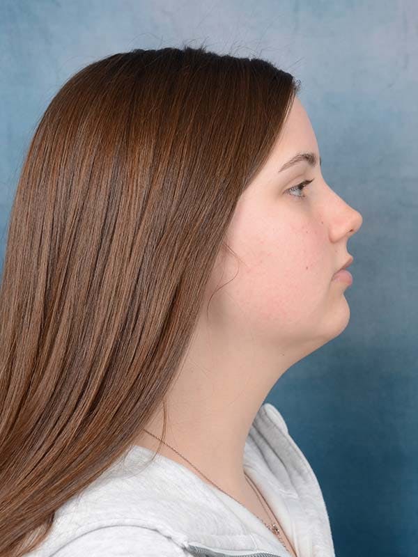 Deep Neck Lift Before & After Gallery - Patient 121440797 - Image 5