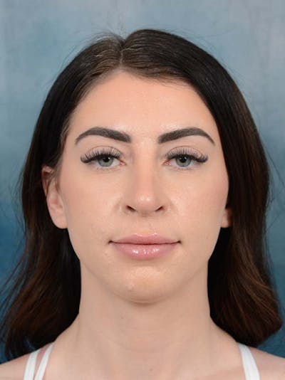 Rhinoplasty Before & After Gallery - Patient 121744665 - Image 4