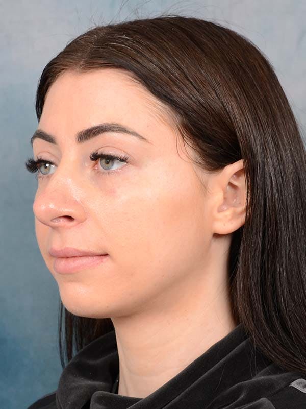 Rhinoplasty Before & After Gallery - Patient 121744665 - Image 5