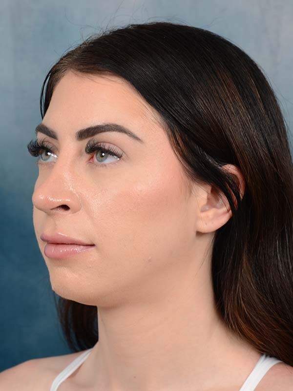 Rhinoplasty Before & After Gallery - Patient 121744665 - Image 6