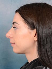 Rhinoplasty Before & After Gallery - Patient 121744665 - Image 1