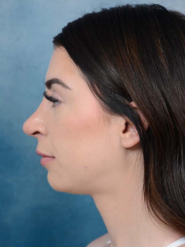 Rhinoplasty Before & After Gallery - Patient 121744665 - Image 2