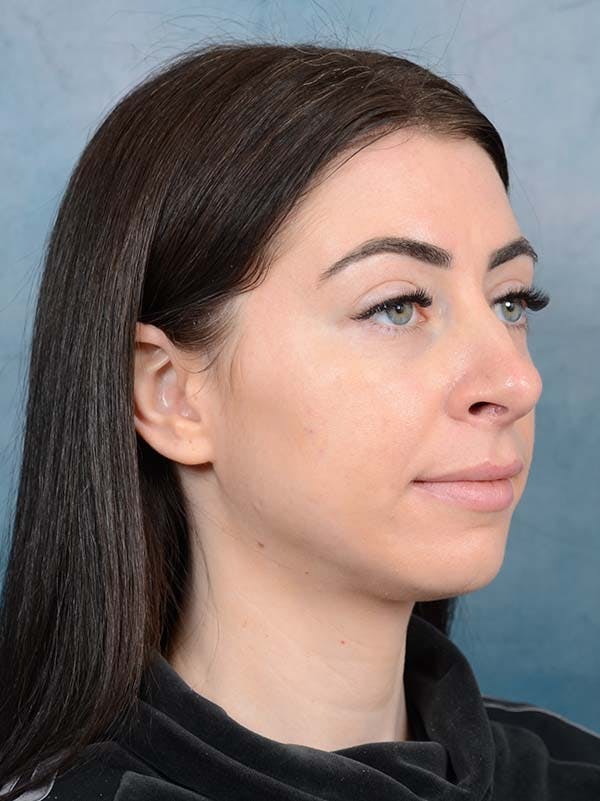 Rhinoplasty Before & After Gallery - Patient 121744665 - Image 7