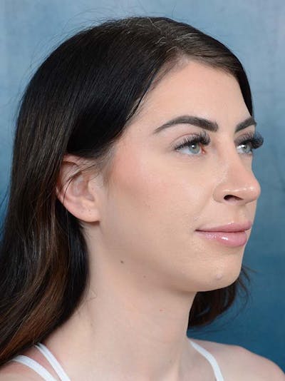 Rhinoplasty Before & After Gallery - Patient 121744665 - Image 8
