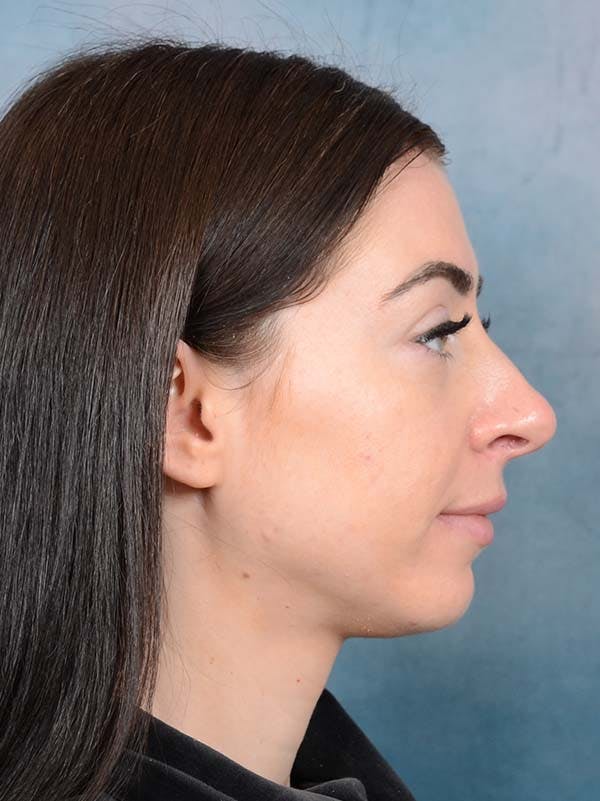 Rhinoplasty Before & After Gallery - Patient 121744665 - Image 9