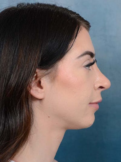 Rhinoplasty Before & After Gallery - Patient 121744665 - Image 10