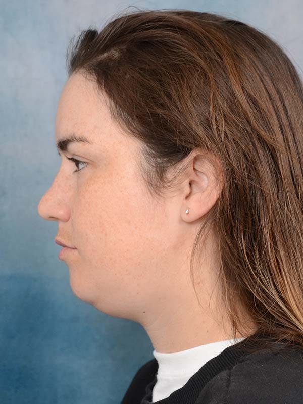 Deep Neck Lift Before & After Gallery - Patient 121744758 - Image 3