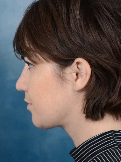 Deep Neck Lift Before & After Gallery - Patient 121744758 - Image 4