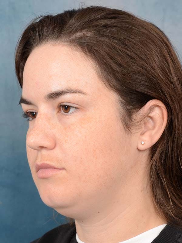 Deep Neck Lift Before & After Gallery - Patient 121744758 - Image 5